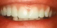 Perfect Smile closed diastema